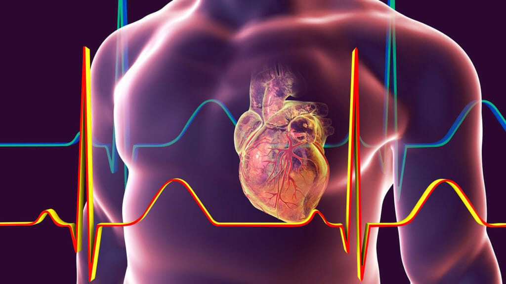 Risk for acute myocardial infarction increased for patients with pneumonia